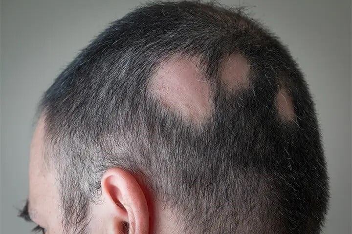 ریزش مو پس از رادیوتراپی مغز