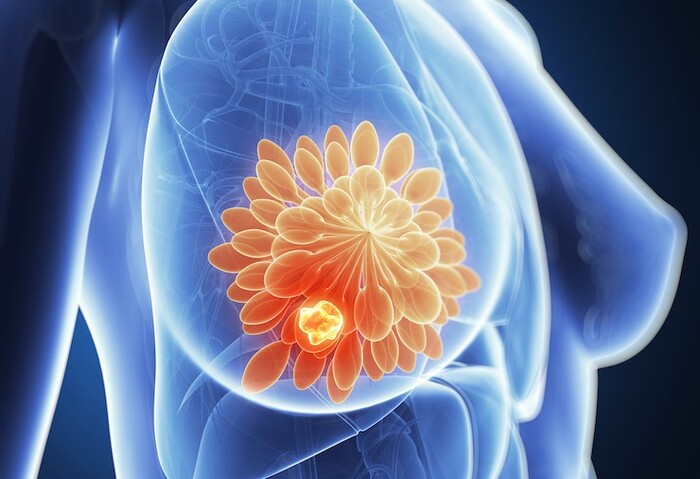 عود مجدد سرطان سینه به چه معناست؟