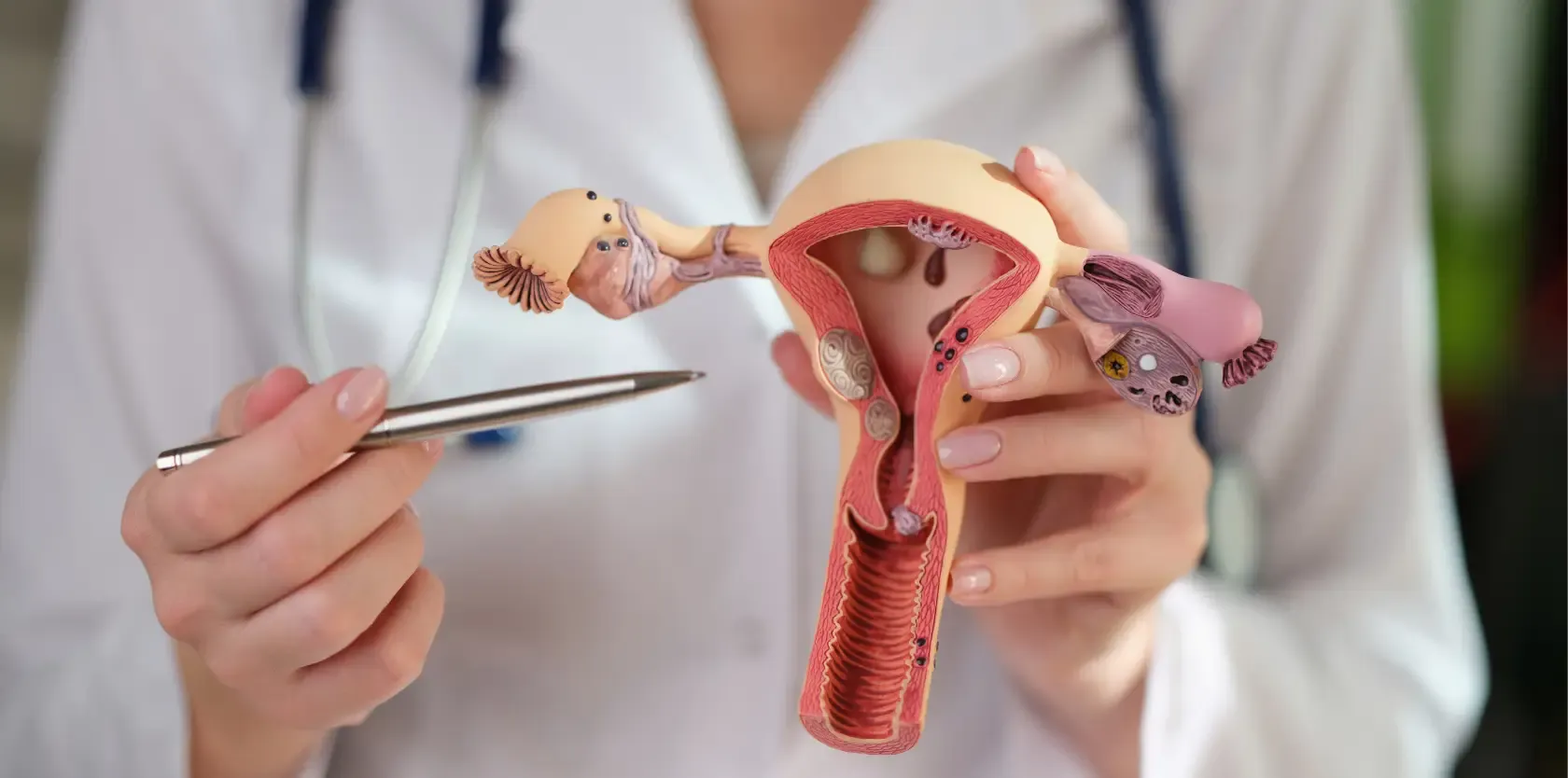 عوامل ریسک رحم و تاثیر آن بر غدد لنفاوی