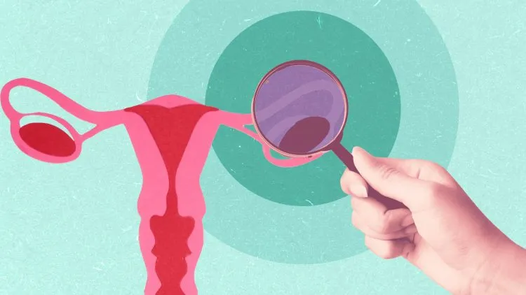 تاثیر سرطان رحم  بر غدد لنفاوی