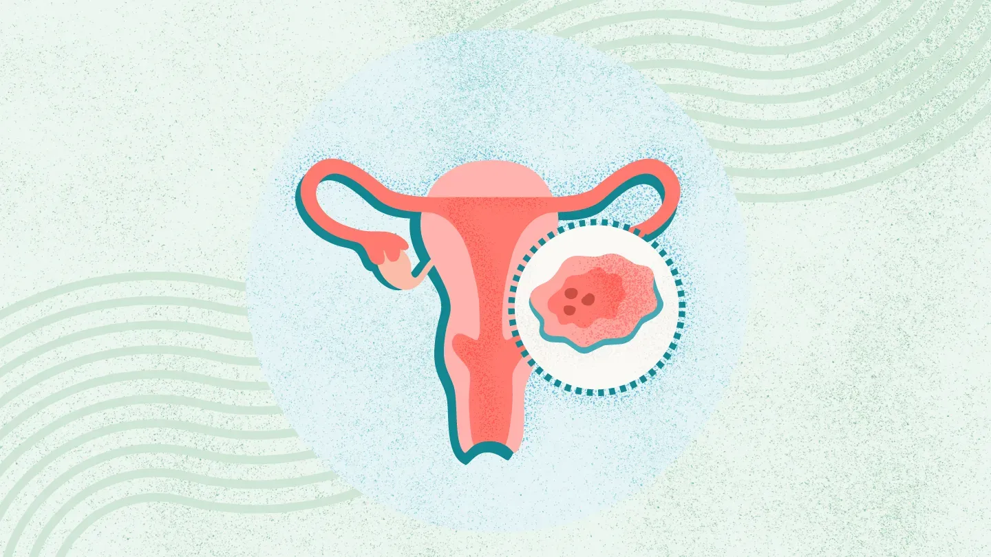 تاثیر سرطان رحم بر غدد لنفاوی