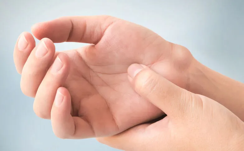 درمان کیست گانگلیون