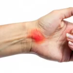 درمان کیست گانگلیون